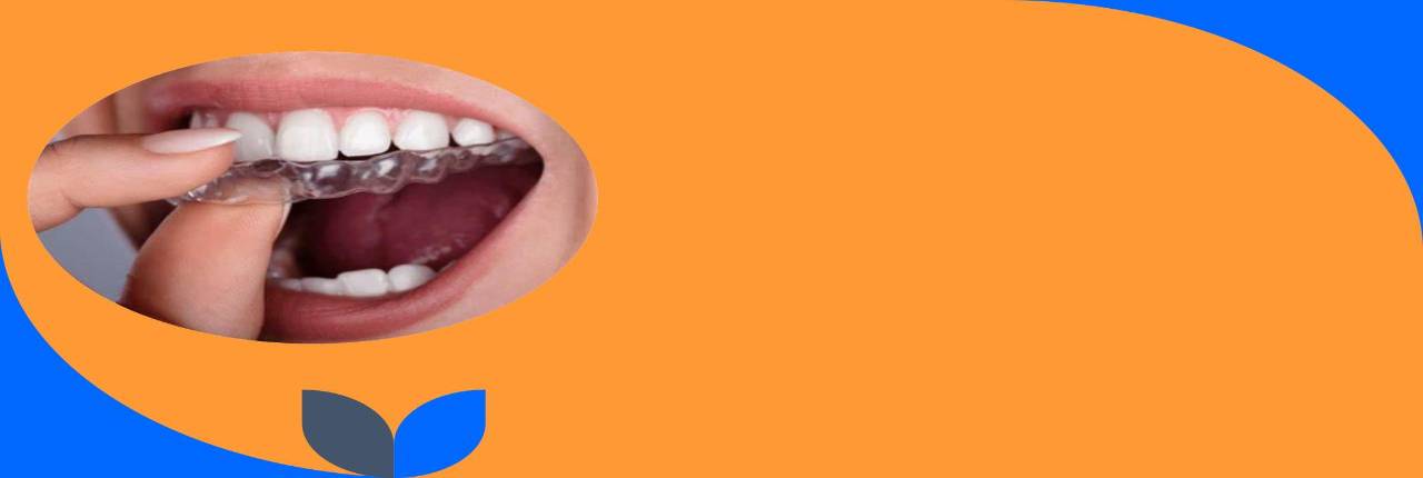 immagine di allineatori invisibili notturni